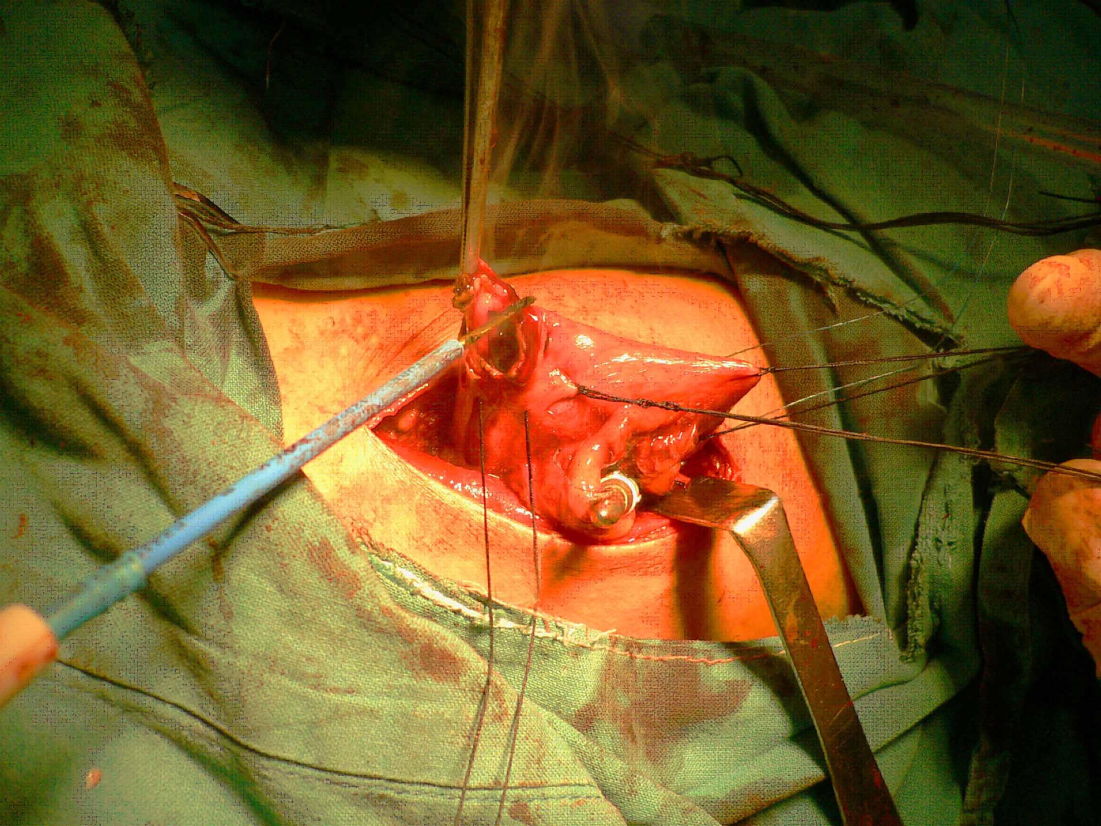 在荷包缝线中心点用止血钳提起胃壁,电刀平行切除部分胃壁