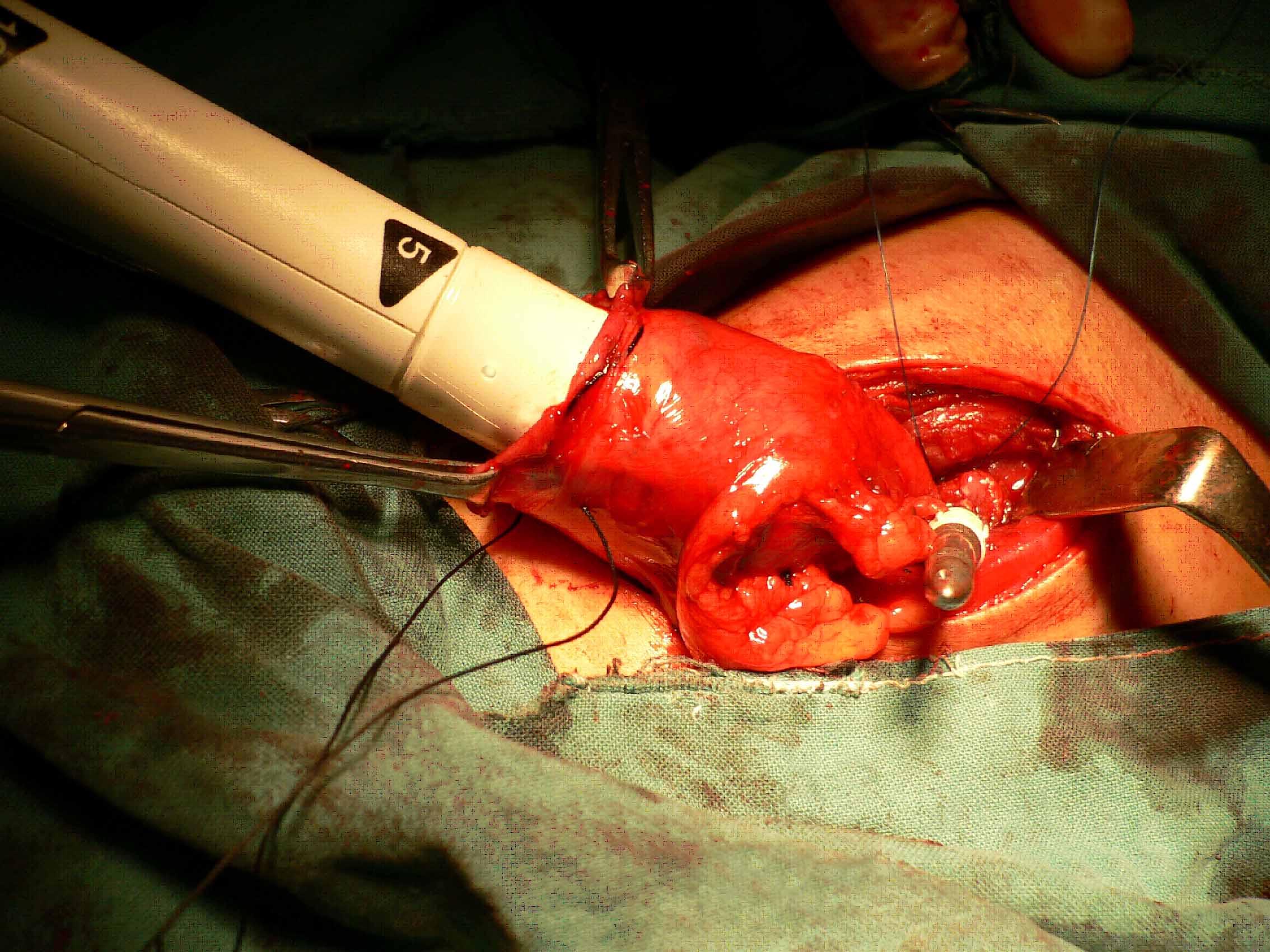 "胃食管颈部器械吻合新方法治疗高位食管癌"达国内领先-天津市肿瘤