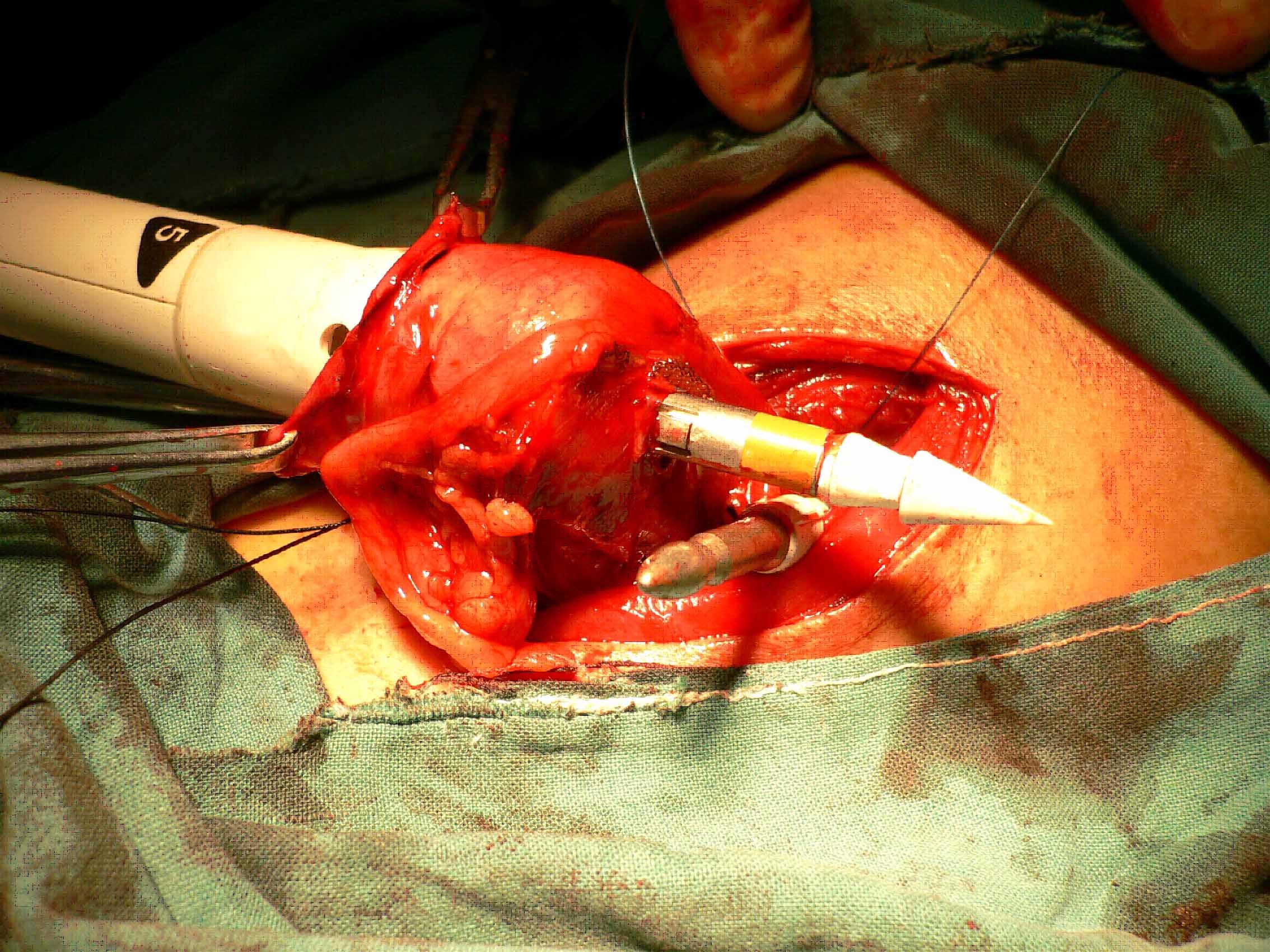 吻合器主机从胃底穿出