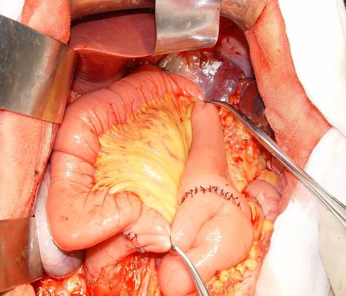 时间: 2008-09-08 来源: 天津市肿瘤医院