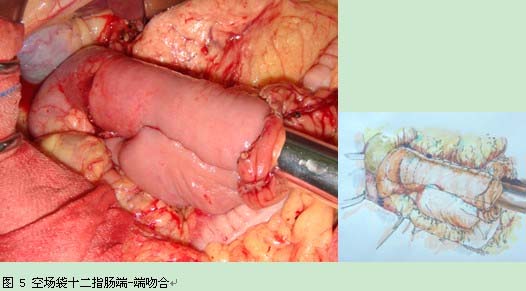 空场袋十二指肠端-端吻合